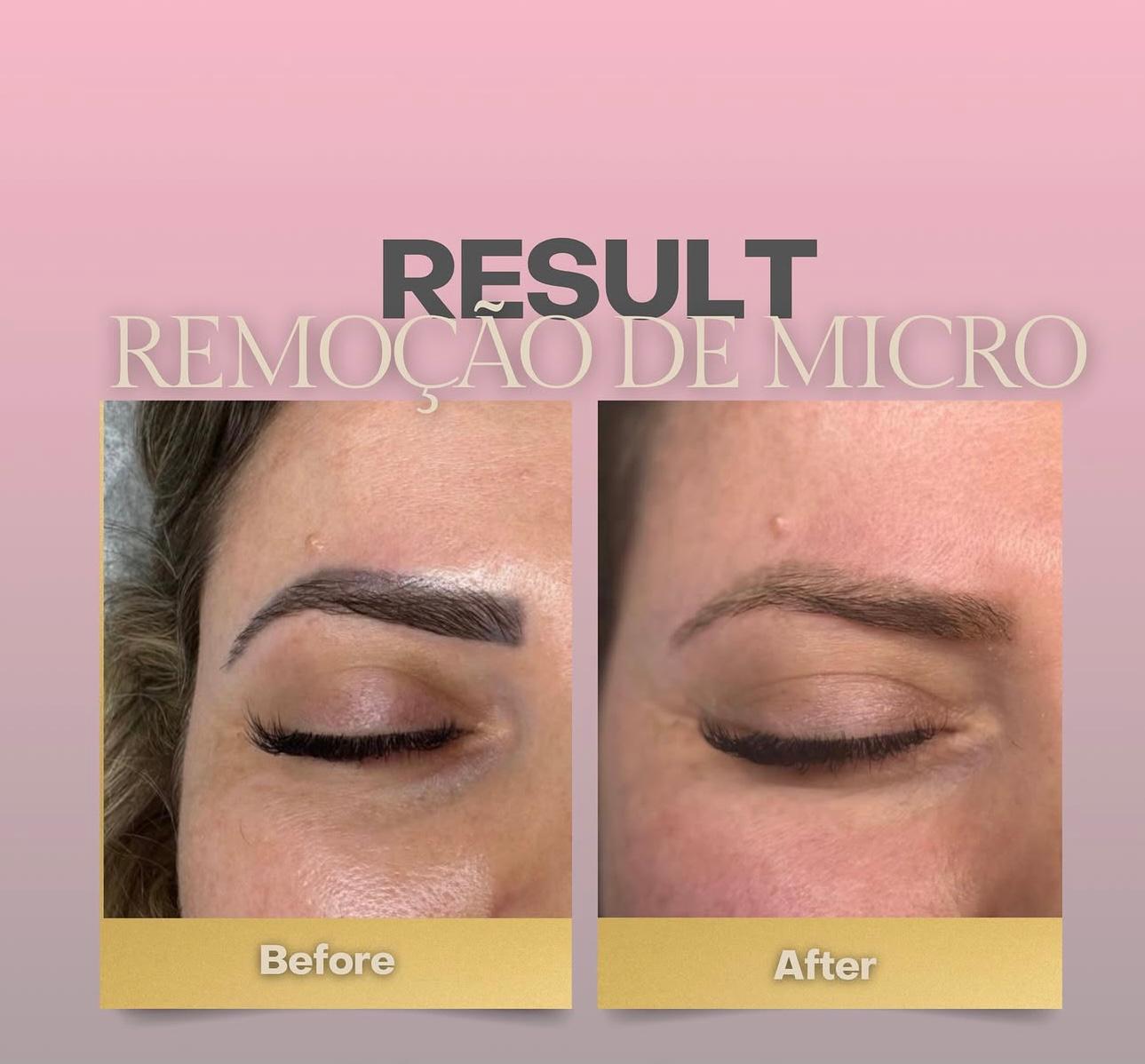 Laser tattoo removal before and after results